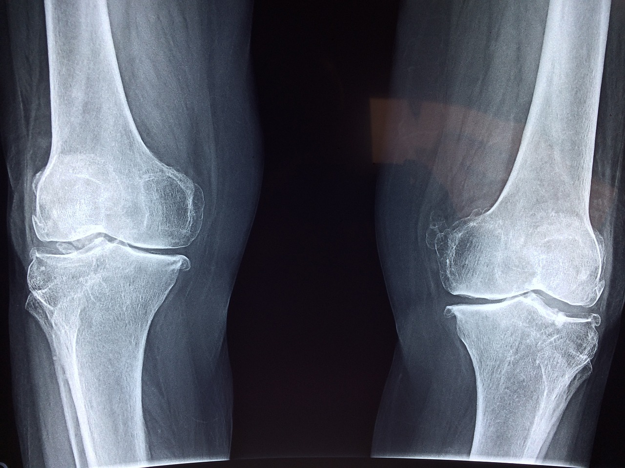 xray image of healthy knee joint